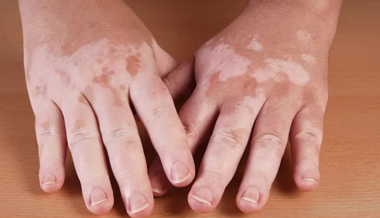 White Spots On Skin: Causes And How To Get Rid of Them