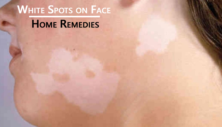 Home Remedies To Treat White Spots on Face