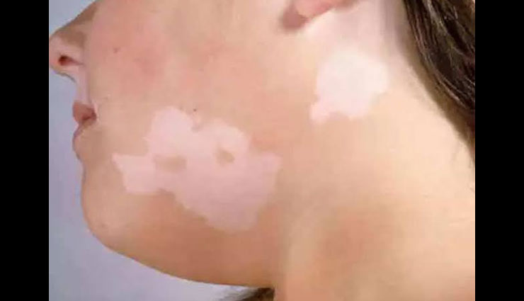white spots on face,remedies for white spots on face,home remedies,skin care tips,beauty tips