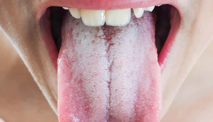 5 Home Remedies To Help You Get Rid of White Tongue