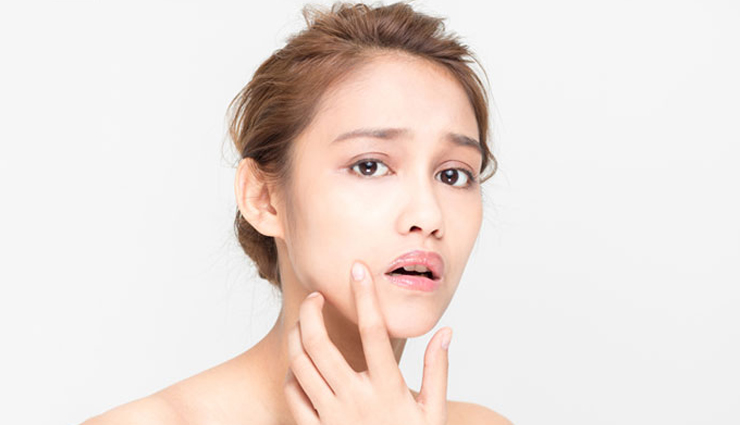 whiteheads,natural remedies,home remedies,home remedies to treat whiteheads,skin care tips,beauty tips