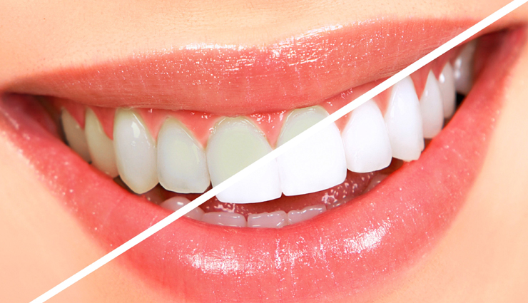 6 Must Try Home Remedies To Whiten Teeth
