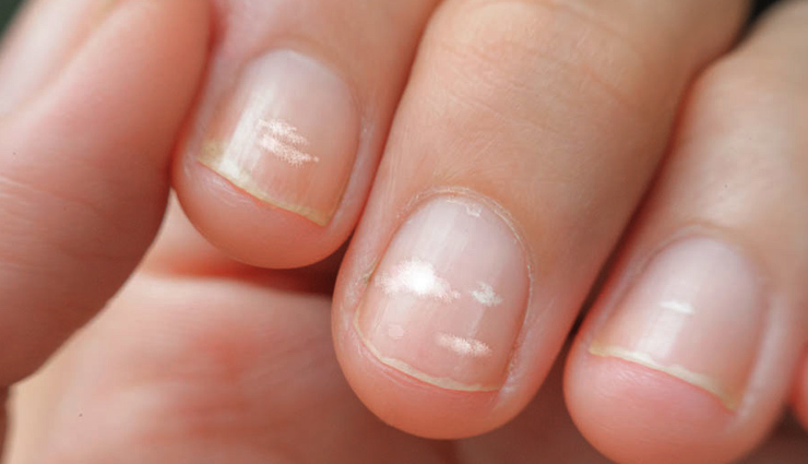 नाखून में सफेद दाग को कैल्शियम की कमी समझना है एक बड़ी गलती, आज जान लें सच्चाई 