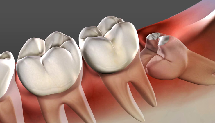 The Ins and Outs of Wisdom Teeth Removal in Melbourne