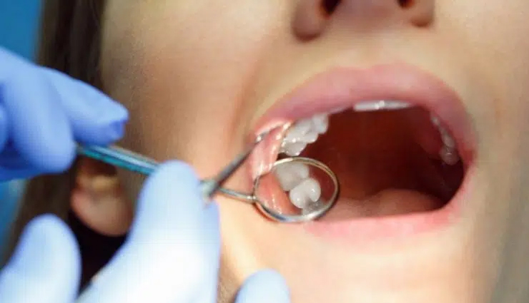 wisdom teeth extraction procedure,preparing for wisdom teeth removal,recovery after wisdom teeth removal,wisdom teeth removal pain management,risks of wisdom teeth extraction,cost of wisdom teeth removal,aftercare for wisdom teeth removal,complications of wisdom teeth removal,common questions about wisdom teeth extraction,benefits of wisdom teeth removal,alternatives to wisdom teeth extraction,impacted wisdom teeth and their removal,wisdom teeth removal for crowded teeth,wisdom teeth removal for orthodontic reasons,surgical and non-surgical wisdom teeth extraction