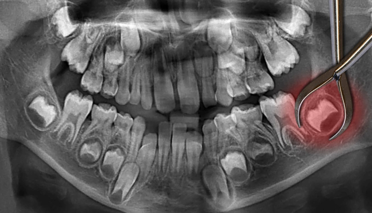 wisdom teeth extraction procedure,preparing for wisdom teeth removal,recovery after wisdom teeth removal,wisdom teeth removal pain management,risks of wisdom teeth extraction,cost of wisdom teeth removal,aftercare for wisdom teeth removal,complications of wisdom teeth removal,common questions about wisdom teeth extraction,benefits of wisdom teeth removal,alternatives to wisdom teeth extraction,impacted wisdom teeth and their removal,wisdom teeth removal for crowded teeth,wisdom teeth removal for orthodontic reasons,surgical and non-surgical wisdom teeth extraction