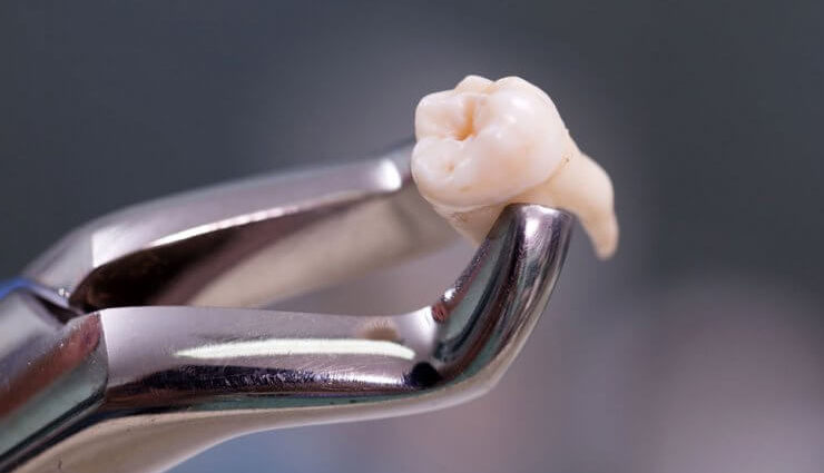 wisdom teeth extraction procedure,preparing for wisdom teeth removal,recovery after wisdom teeth removal,wisdom teeth removal pain management,risks of wisdom teeth extraction,cost of wisdom teeth removal,aftercare for wisdom teeth removal,complications of wisdom teeth removal,common questions about wisdom teeth extraction,benefits of wisdom teeth removal,alternatives to wisdom teeth extraction,impacted wisdom teeth and their removal,wisdom teeth removal for crowded teeth,wisdom teeth removal for orthodontic reasons,surgical and non-surgical wisdom teeth extraction