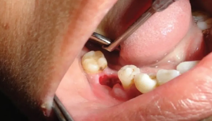 wisdom teeth extraction procedure,preparing for wisdom teeth removal,recovery after wisdom teeth removal,wisdom teeth removal pain management,risks of wisdom teeth extraction,cost of wisdom teeth removal,aftercare for wisdom teeth removal,complications of wisdom teeth removal,common questions about wisdom teeth extraction,benefits of wisdom teeth removal,alternatives to wisdom teeth extraction,impacted wisdom teeth and their removal,wisdom teeth removal for crowded teeth,wisdom teeth removal for orthodontic reasons,surgical and non-surgical wisdom teeth extraction