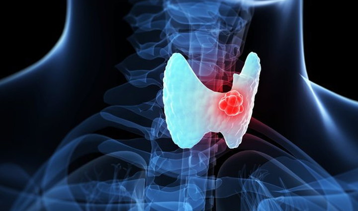 be alert as soon as these symptoms appear in women there can be a risk of thyroid cancer,Health,healthy living