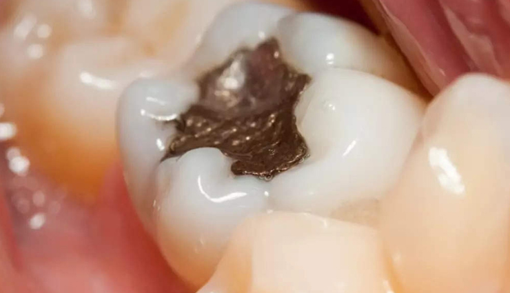 गंभीर होने से पहले ही इन 10 घरेलू नुस्खों से दूर करें दांत में लगे कीड़े की परेशानी 