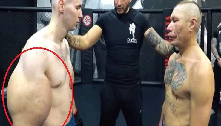 बाइसेप्स-ट्राइसेप्स  बनाने के चक्कर में इस बॉडीबिल्डर ने लिया सिंथॉल इंजेक्शन, गुब्बारे की तरह फूल गए हाथ 