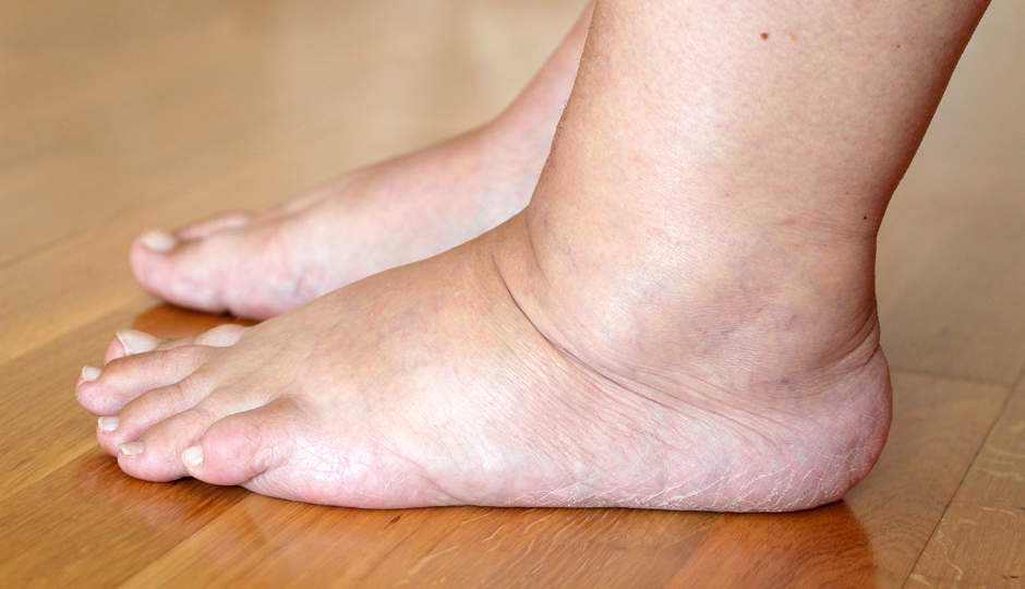 8 Big Reasons for Water Retention in The Body