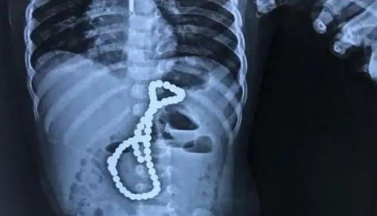 बच्चे के पेट में निकली ऐसी चीज जिसे देख डॉक्टर भी रह गए हैरान