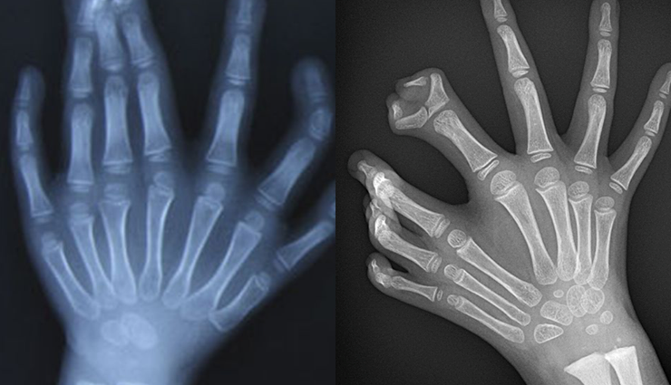 mirror hand syndrome diagnosis,treatment for mirror hand syndrome,mirror hand syndrome therapy,mirror hand syndrome rehabilitation,coping with mirror hand syndrome,mirror hand syndrome management,mirror hand syndrome prognosis,mirror hand syndrome symptoms,mirror hand syndrome causes,mirror hand syndrome specialist,mirror hand syndrome exercises,mirror hand syndrome physiotherapy,mirror hand syndrome research,mirror hand syndrome neurology,mirror hand syndrome rehabilitation exercises,mirror hand syndrome specialists,mirror hand syndrome physical therapy,coping strategies for mirror hand syndrome,mirror hand syndrome case studies,mirror hand syndrome prognosis and outlook,mirror hand syndrome surgical options,mirror hand syndrome therapies,mirror hand syndrome neurological disorder