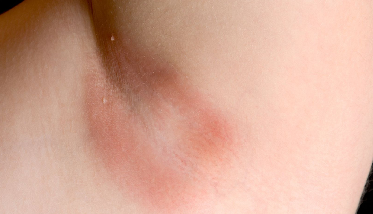 underarm allergies,causes of underarm allergies,allergy,underarm allergies remedies,skin,skin care tips,beauty,beauty tips