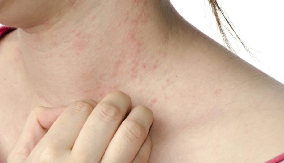 7 Body Areas That Get Affected By Yeast Infection