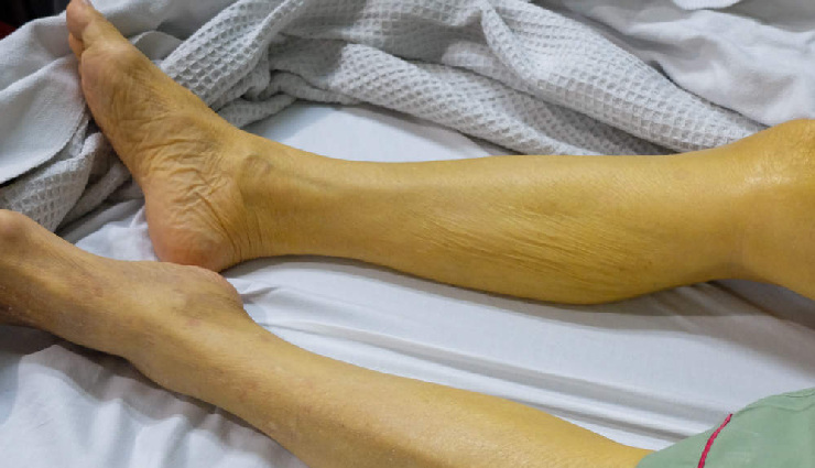 सिरदर्द, कमजोरी और थकान: विटामिन बी12 की कमी के प्रमुख लक्षण vitamin b12 deficiency symptoms,signs of b12 deficiency,how to know if you have b12 deficiency,symptoms of low vitamin b12,vitamin b12 deficiency causes,b12 deficiency and fatigue,vitamin b12 deficiency effects,early signs of b12 deficiency,b12 deficiency symptoms in adults,how to detect b12 deficiency,importance of vitamin b12 in the body