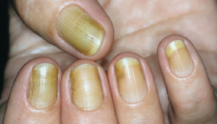 7 Effective Home Remedies To Treat Yellow Nail Syndrome