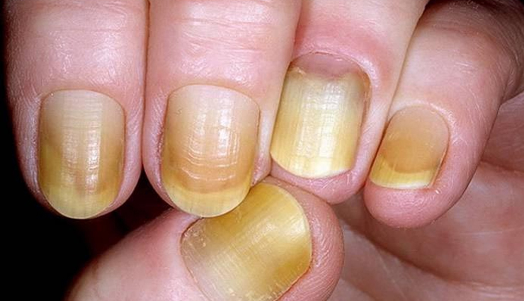 6 Effective Home Remedies To Treat Yellow Nails