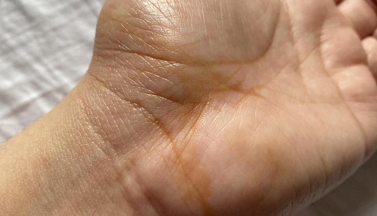 कोलेस्ट्रॉल जब बढ़ जाए हद से ज्यादा तो हाथों-पैरों की उंगलियों पर दिखते हैं ये लक्षण, नजरअंदाज करना पड़ सकता है महंगा cholesterol symptoms extremities,warning signs of high cholesterol,cholesterol effects on fingers and toes,recognizing cholesterol-related symptoms,signs of elevated cholesterol levels,cholesterol symptoms in hands and feet,importance of detecting cholesterol symptoms,cholesterol indicators on fingers and toes,identifying cholesterol warning signs,cholesterol-related symptoms awareness