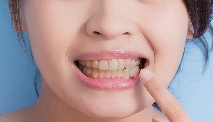 5 Natural Ways To Treat Yellow Teeth