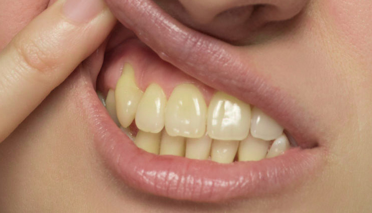 आपके आकर्षण में कमी ला सकता हैं दांतों का पीलापन, इन घरेलू उपायों से दें इन्हें सफेद चमक 