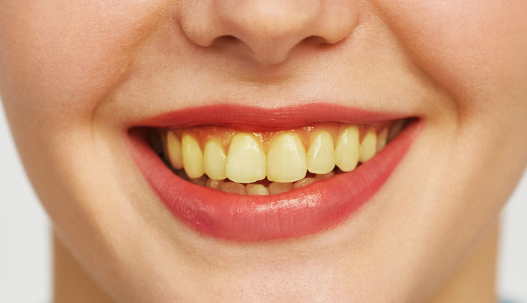7 DIY Ways To Help You Whiten Yellow Teeth