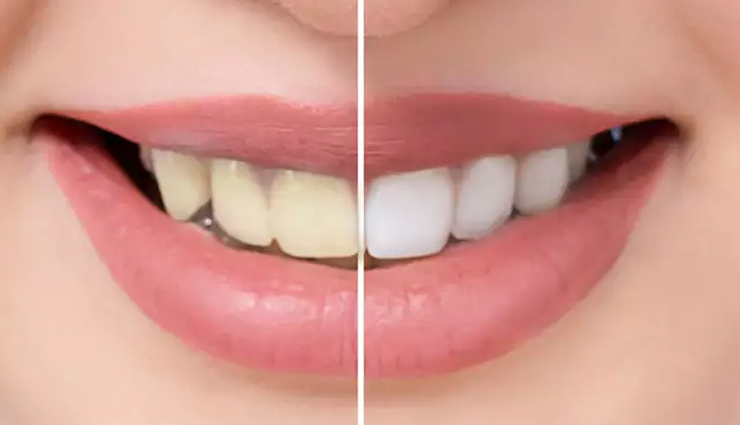 yellow teeth,home remedies,home remedies to treat yellow teeth,teeth care tips,Health tips,fitness tips
