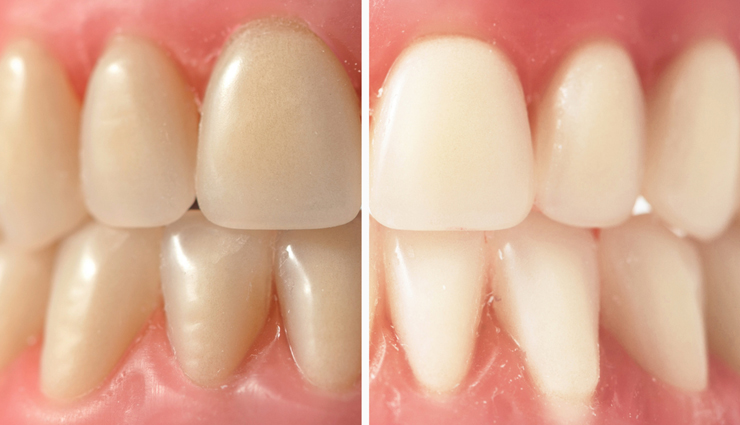 Causes of Yellow Teeth and 8 Effective Home Remedies to Whiten Them