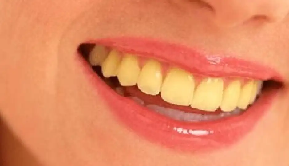 alum for teeth whitening,fitkari benefits for teeth,yellow teeth home remedy,dental plaque removal,oral hygiene tips,alum powder for teeth,natural teeth cleaning,teeth whitening remedies,bad breath treatment,tartar removal home remedy,healthy teeth tips,dental care at home