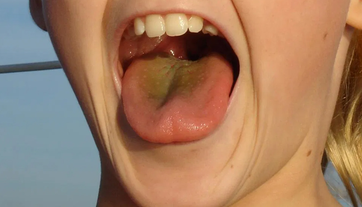 5 Habits You Need To Adopt To Get Rid of Yellow Tongue