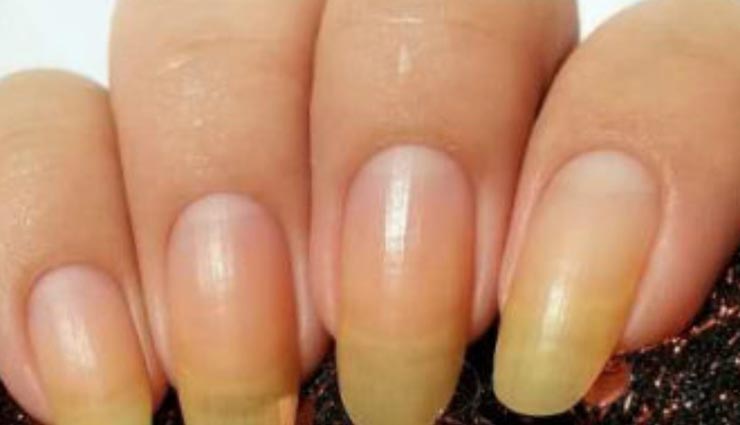 नाखूनों का पीलापन हटाए इन उपायों से, बढ़ेगी हाथों की खूबसूरती