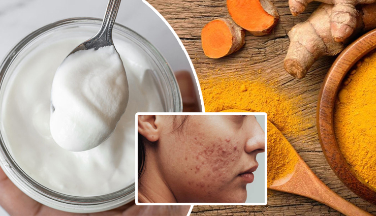 Unlock Clearer Skin with a Yogurt and Turmeric Pack for Acne