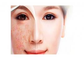 சருமத்தில் உள்ள கரும்புள்ளிகளை இயற்கை முறையில் அகற்றுவது எப்படி?