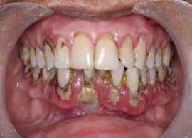 சர்க்கரை நோய் உள்ளவர்களுக்கு பல் பாதிப்பு நோய் அதிகம் வர வாய்ப்பு