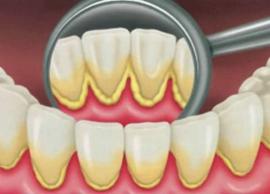 பற்களில் உள்ள மஞ்சள் கறை மறைய எளிய வழிமுறைகள்