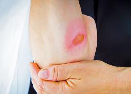 தீப்புண்ணை ஆற்றும் குணம் கொண்டது பீட்ரூட்