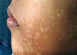 தேமலை போக்க இயற்கை வழிமுறைகள் இருக்கே... இதோ சில டிப்ஸ்