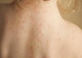 எரிச்சலூட்டும் வியர்க்குருவை விரட்ட சில இயற்கை வழிமுறைகள்