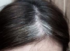 இளநரை வருவதற்கான காரணம்... அதற்காக தீர்வு