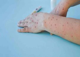 தக்காளி காய்ச்சல் பரவலை தடுக்க நடவடிக்கை எடுக்குமாறு மாநிலங்களுக்கு மத்திய அரசு அறிவுறுத்தல்