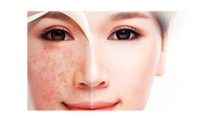 natural,bleaching,skin,dark spots,face ,இயற்கை, ப்ளீச்சிங், சருமம், கரும்புள்ளிகள், முகம்