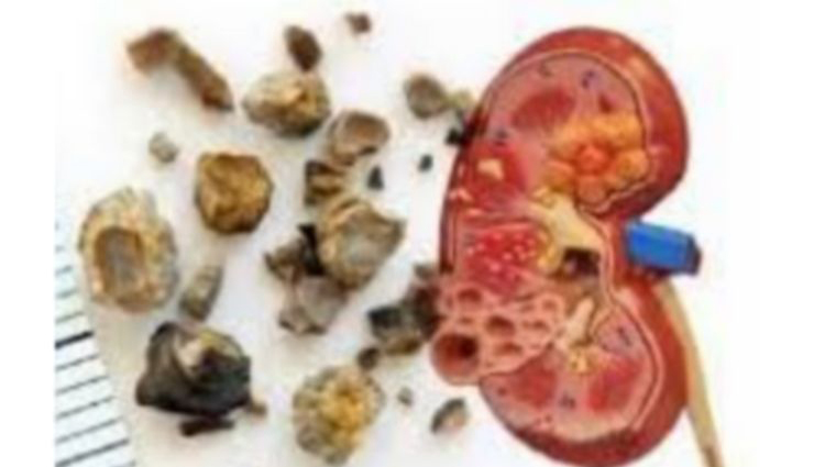 kidney stones,siddars,dissolving,simple method ,சிறுநீரக கற்கள், சித்தர்கள், கரைக்கும், எளிய முறை