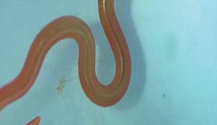 parasitic worm,female brain,alive,removed,australia ,ஒட்டுண்ணி புழு, பெண் மூளை, உயிருடன், அகற்றினர், ஆஸ்திரேலியா