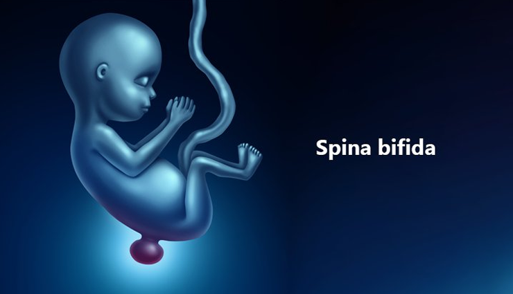 birth defects,spina bifida,encephalocele,pregnancy ,பிறப்பு குறைபாடுகள், ஸ்பைனா பிஃபிடா, என்செபலோசெல், கர்ப்பம்