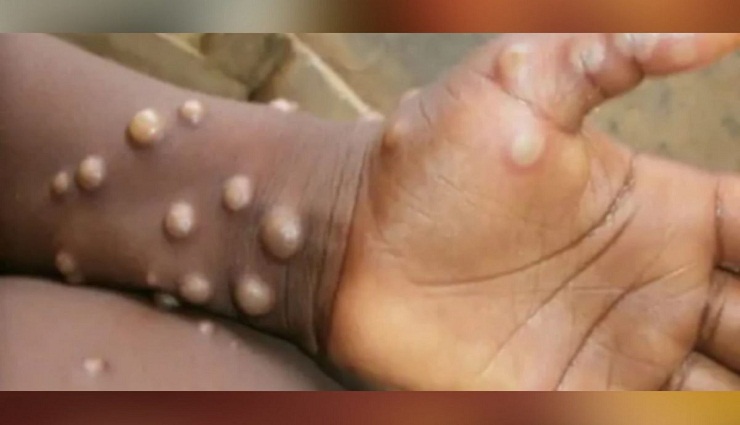 monkey measles,health system ,குரங்கு அம்மை ,சுகாதார அமைப்பு 