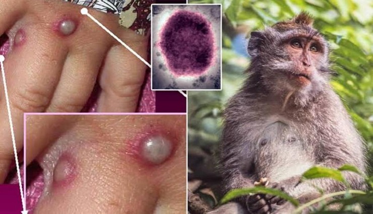 monkey measles,china ,குரங்கு அம்மை,சீனா