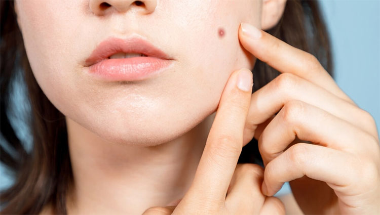 మొటిమలతో బాధపడే వారికి చిన్న టిప్స్
